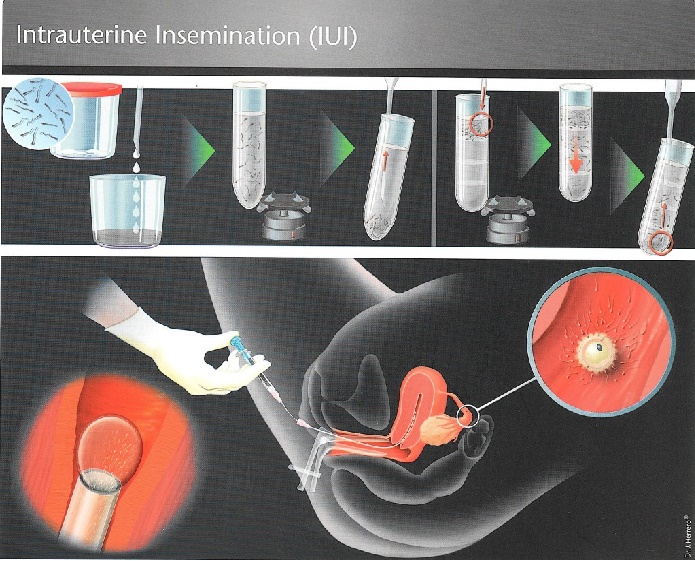 Fertility Clinic in Surat