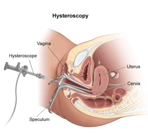 Hysteroscopy cost in India