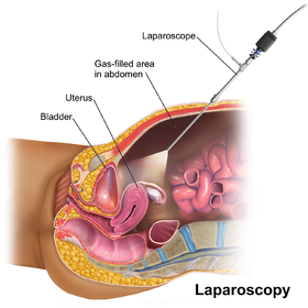 laparoscopy cost in India